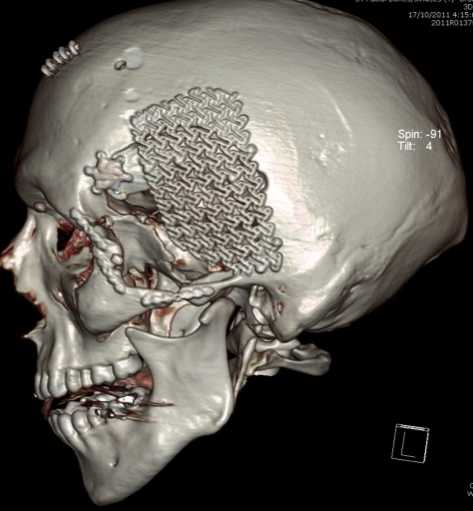 Cranioplasty C N S Neurosurgery