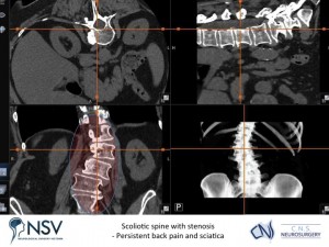 1a. Advanced Spinal