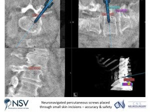 1d. Advanced Spinal