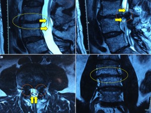 3a. Advanced Spinal