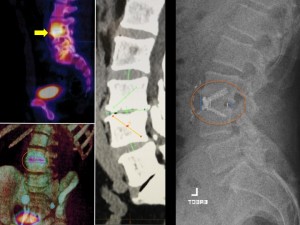 3b. Advanced Spinal