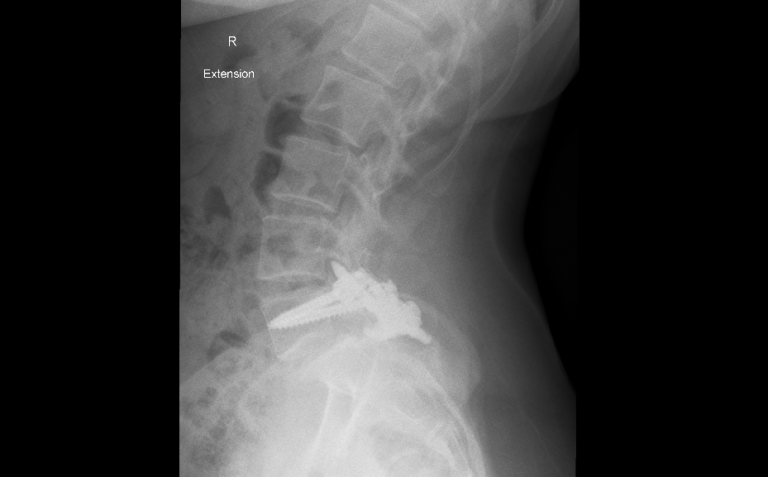 A minimally invasive anterior approach (ALIF) used to replace failed ...