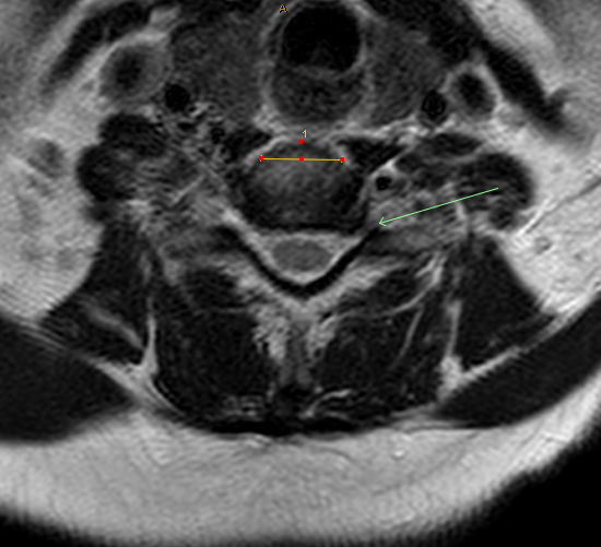 ifactor surgery