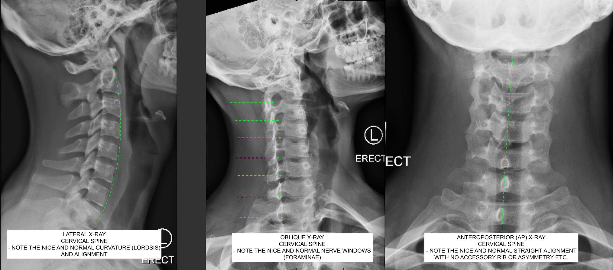 Normal Cervical Spine X Rays Sample Cervical Spine Radiograph DUFLCY