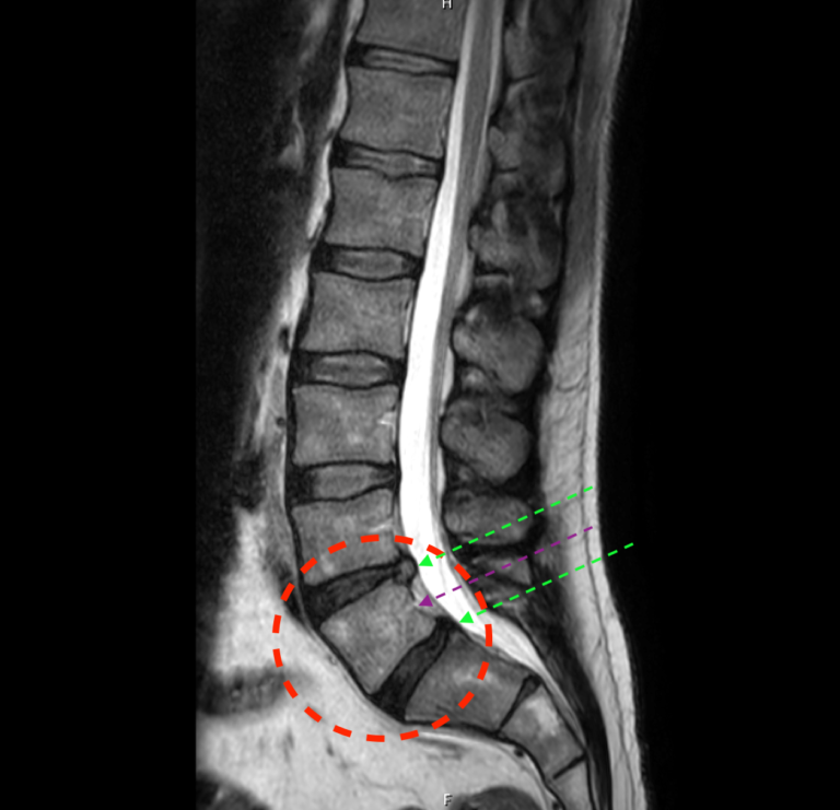 “Lumbarised S1” The transitional (potentially mobile) lumbosacral segment and its excellent