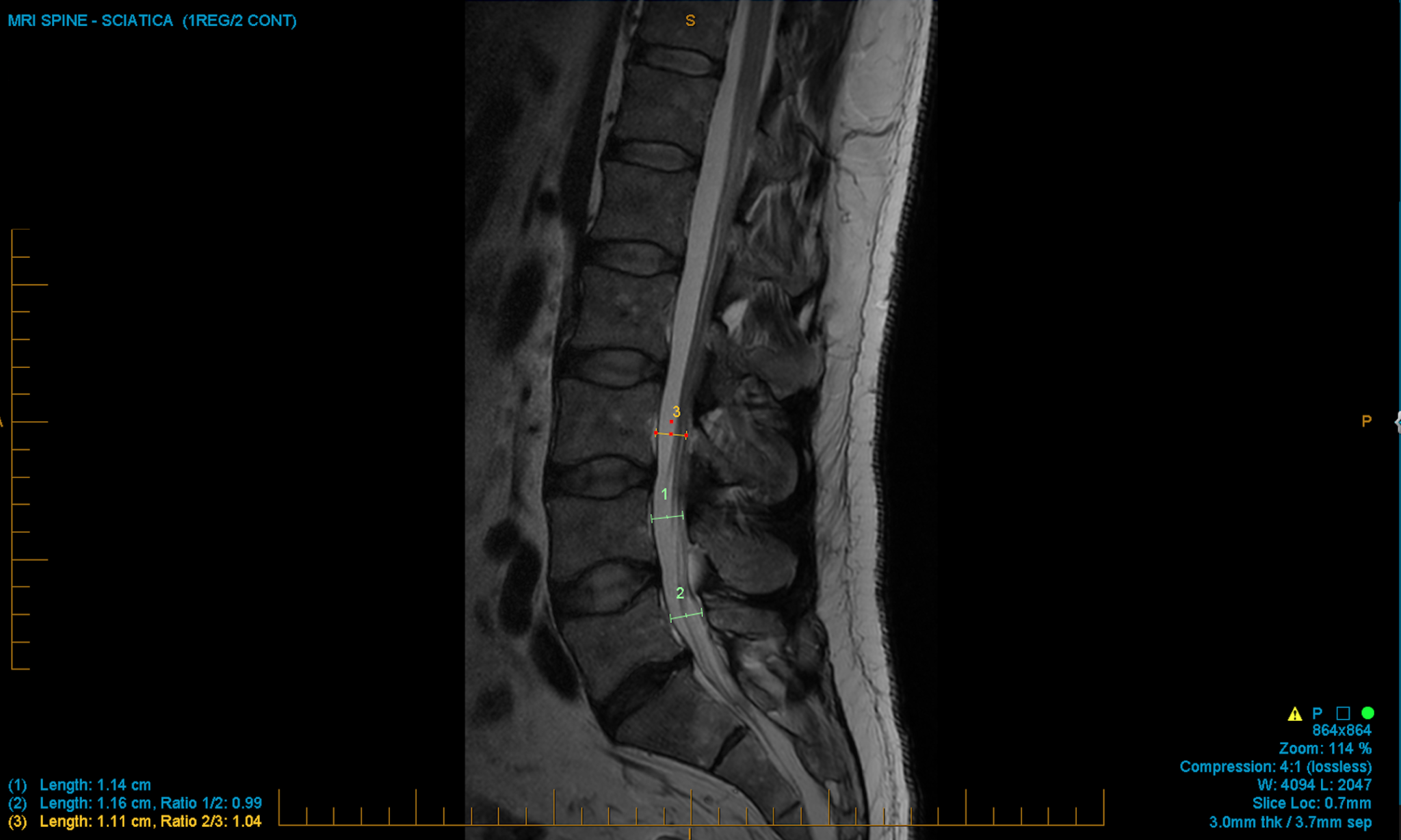 Congenital narrowing of the lumbar spinal canal Implications C.N.S